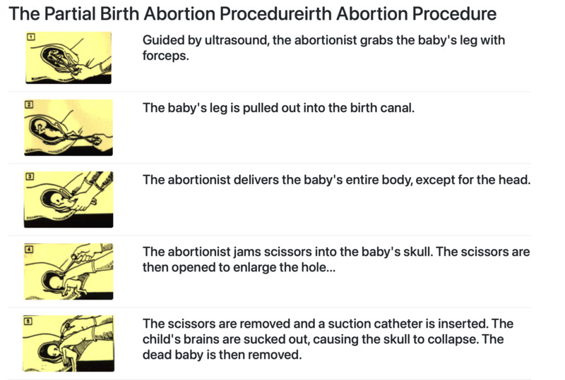 Another chart put out by the National Right to Life organization to depict PBA as gruesome and inhuman. In this chart, the fetus is depicted as clutching its head in pain and also very human like.